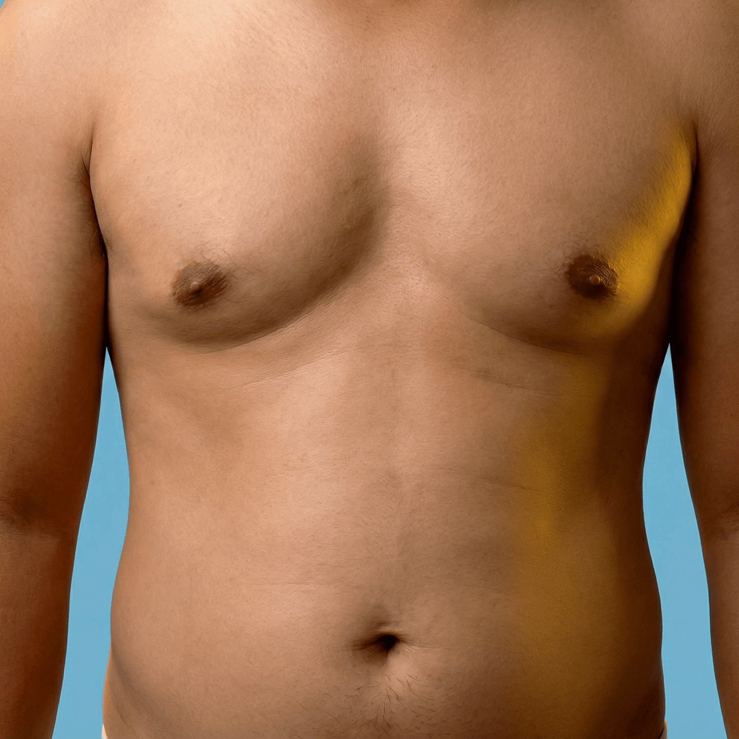 Male plastic surgery