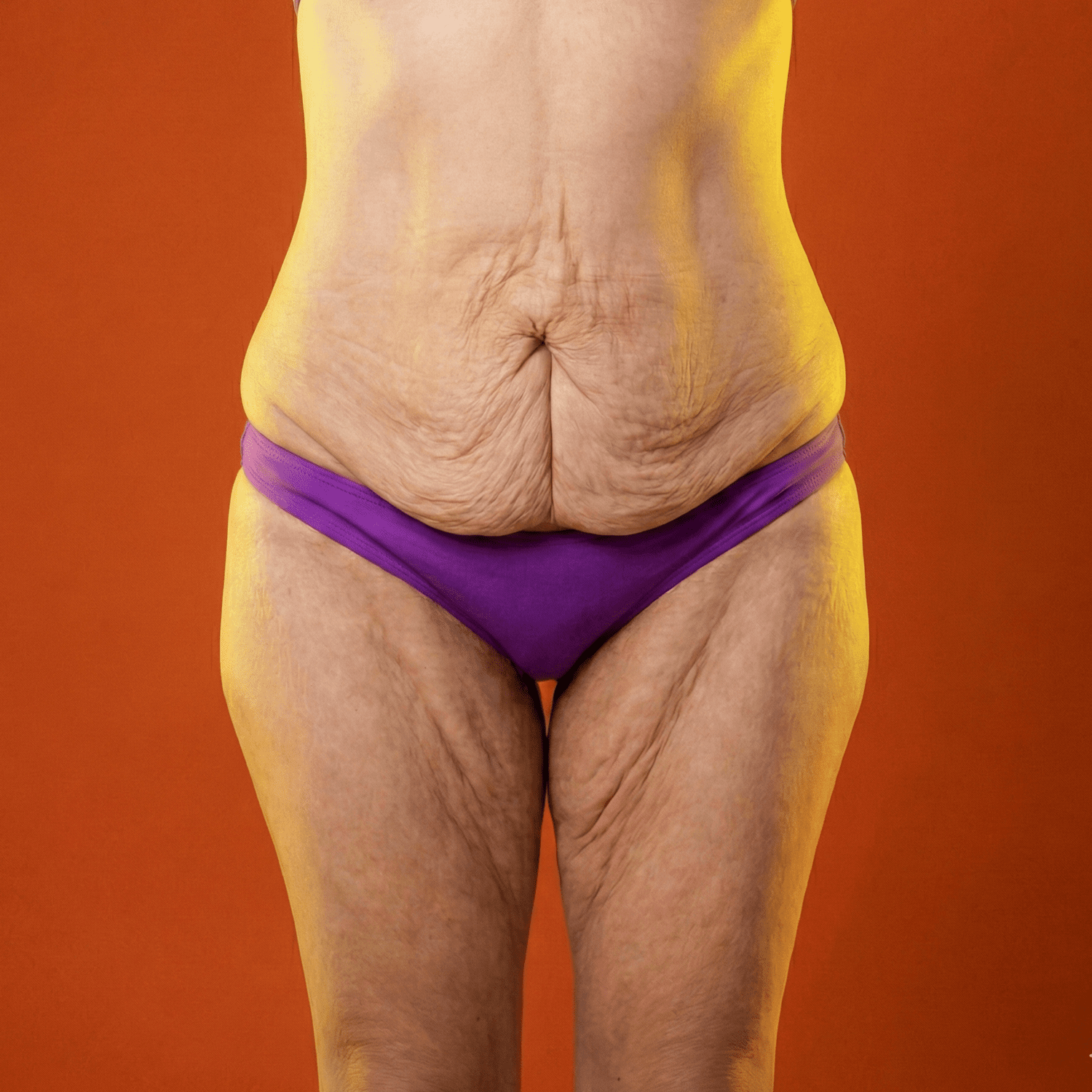 Surgery after major weight loss