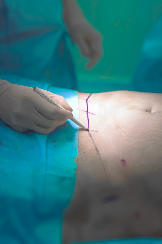 Imagem ilustrativa de Cirurgia de abdominoplastia mais lipo