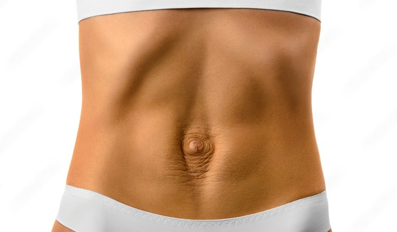 Imagem ilustrativa de Cirurgia de diástase abdominal